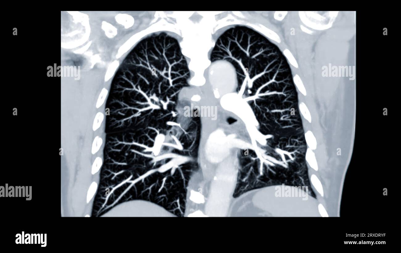CTPA ou CTA artère pulmonaire pour diagnostic d'embolie pulmonaire (EP), de cancer du poumon et de covid-19. . Banque D'Images