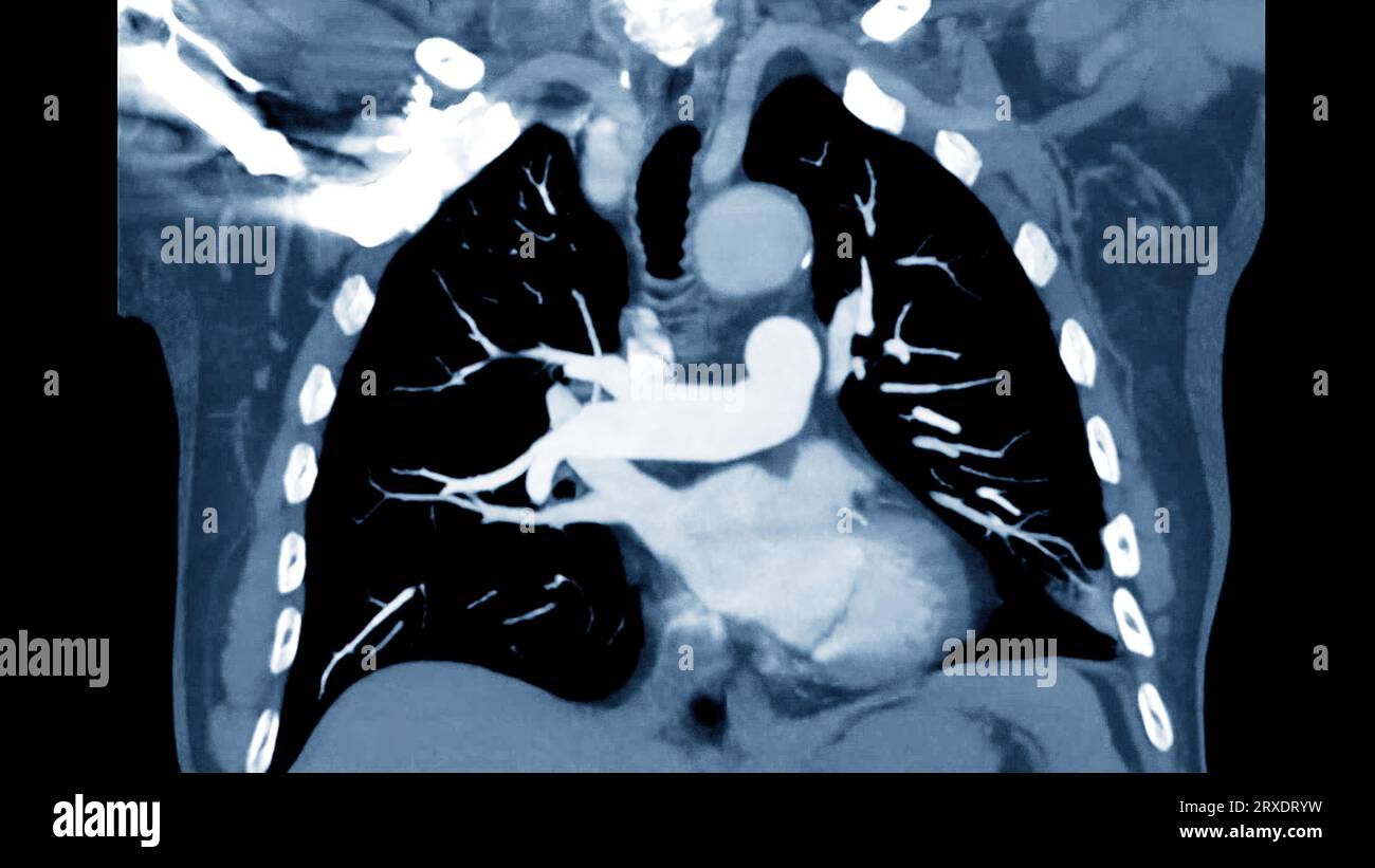 CTPA ou CTA artère pulmonaire pour diagnostic d'embolie pulmonaire (EP), de cancer du poumon et de covid-19. . Banque D'Images