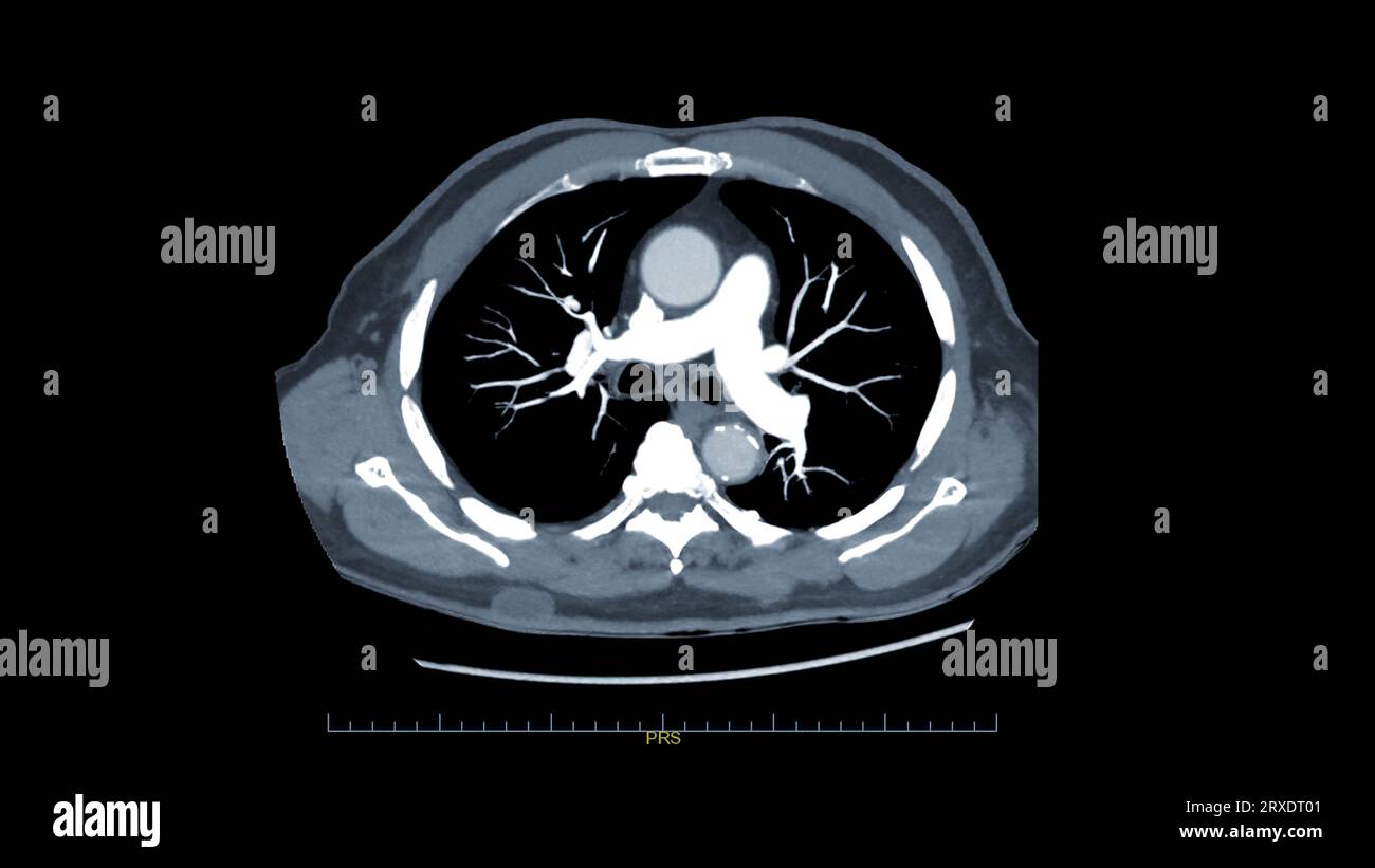 CTPA ou CTA artère pulmonaire pour diagnostic d'embolie pulmonaire (EP), de cancer du poumon et de covid-19. . Banque D'Images