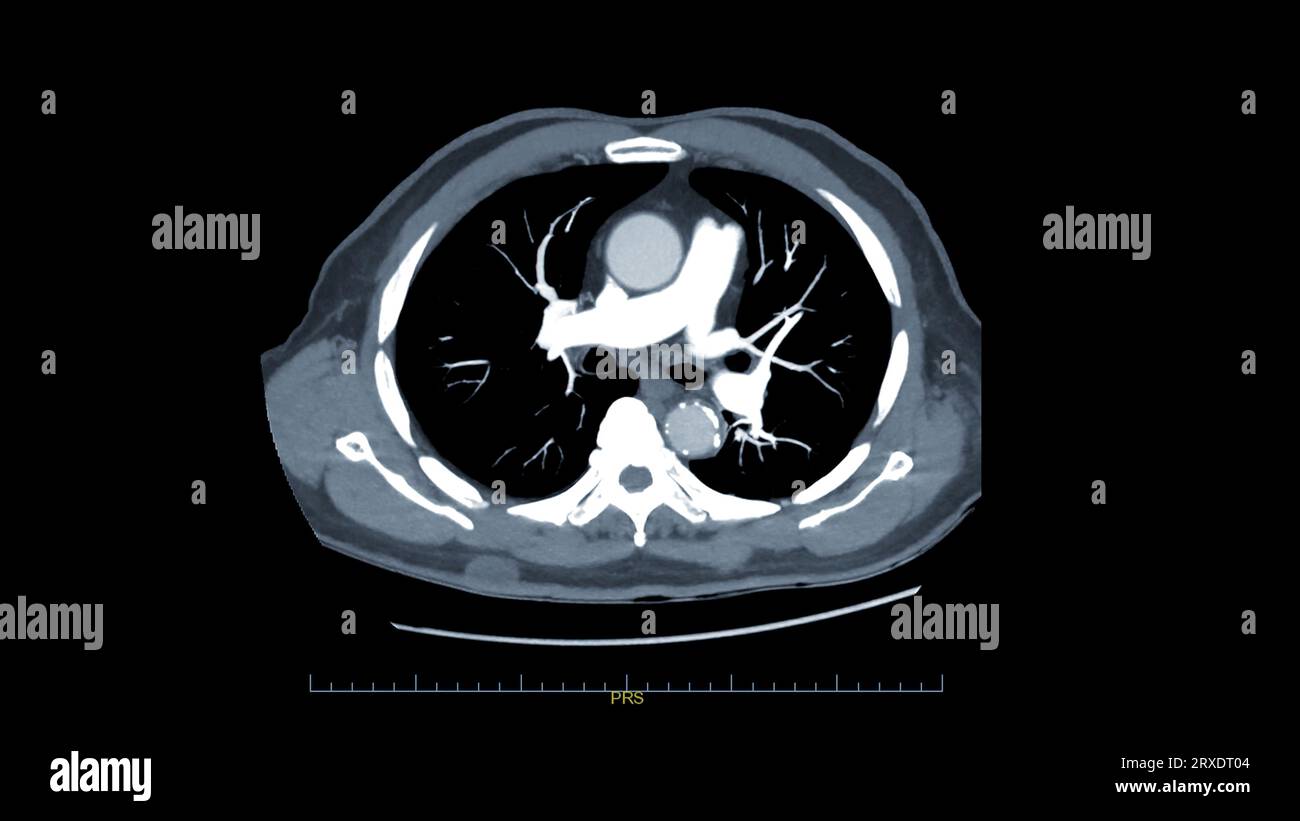 CTPA ou CTA artère pulmonaire pour diagnostic d'embolie pulmonaire (EP), de cancer du poumon et de covid-19. . Banque D'Images