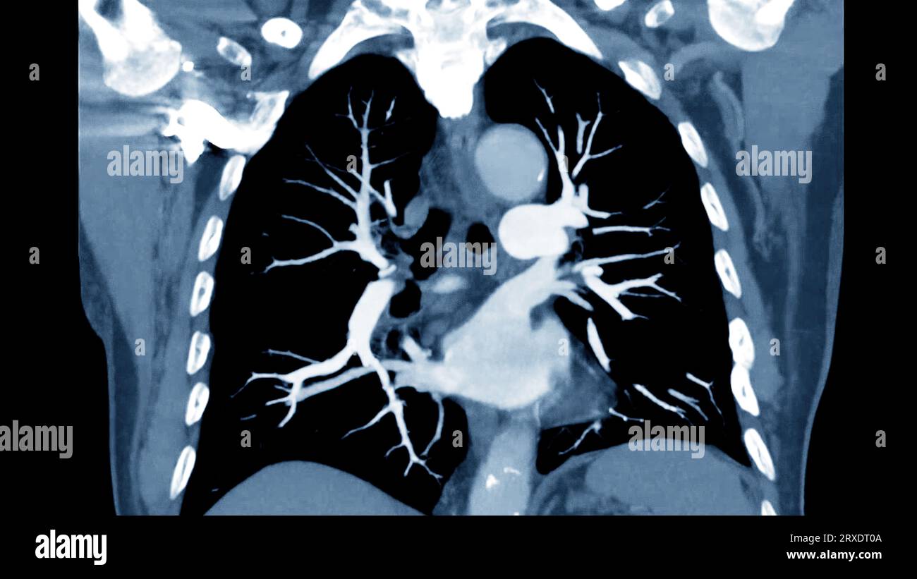 CTPA ou CTA artère pulmonaire pour diagnostic d'embolie pulmonaire (EP), de cancer du poumon et de covid-19. . Banque D'Images