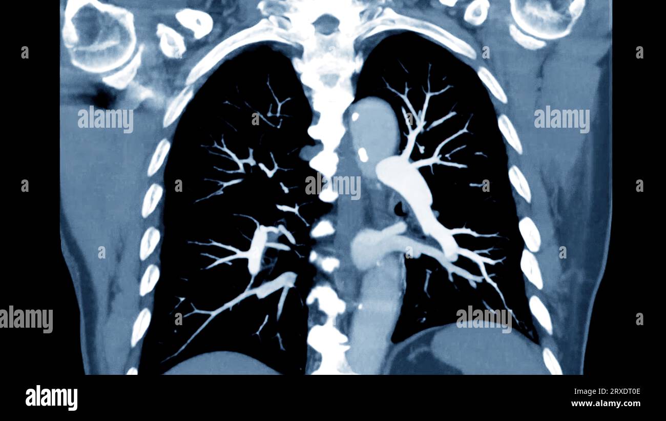 CTPA ou CTA artère pulmonaire pour diagnostic d'embolie pulmonaire (EP), de cancer du poumon et de covid-19. . Banque D'Images
