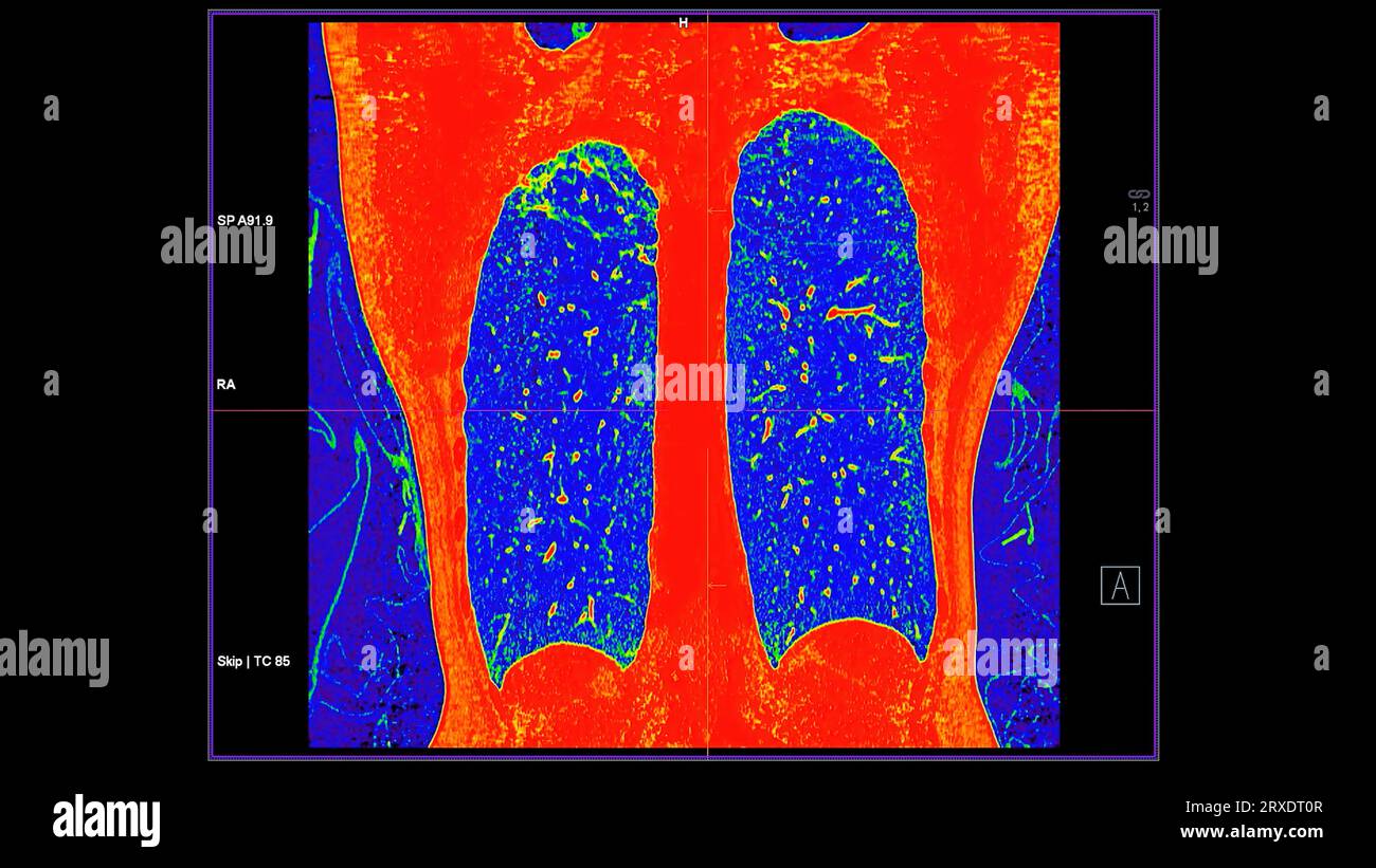Tomodensitométrie de la vue coronale thorax en mode couleur pour le diagnostic d'embolie pulmonaire (EP) , de cancer du poumon et de covid-19. Banque D'Images