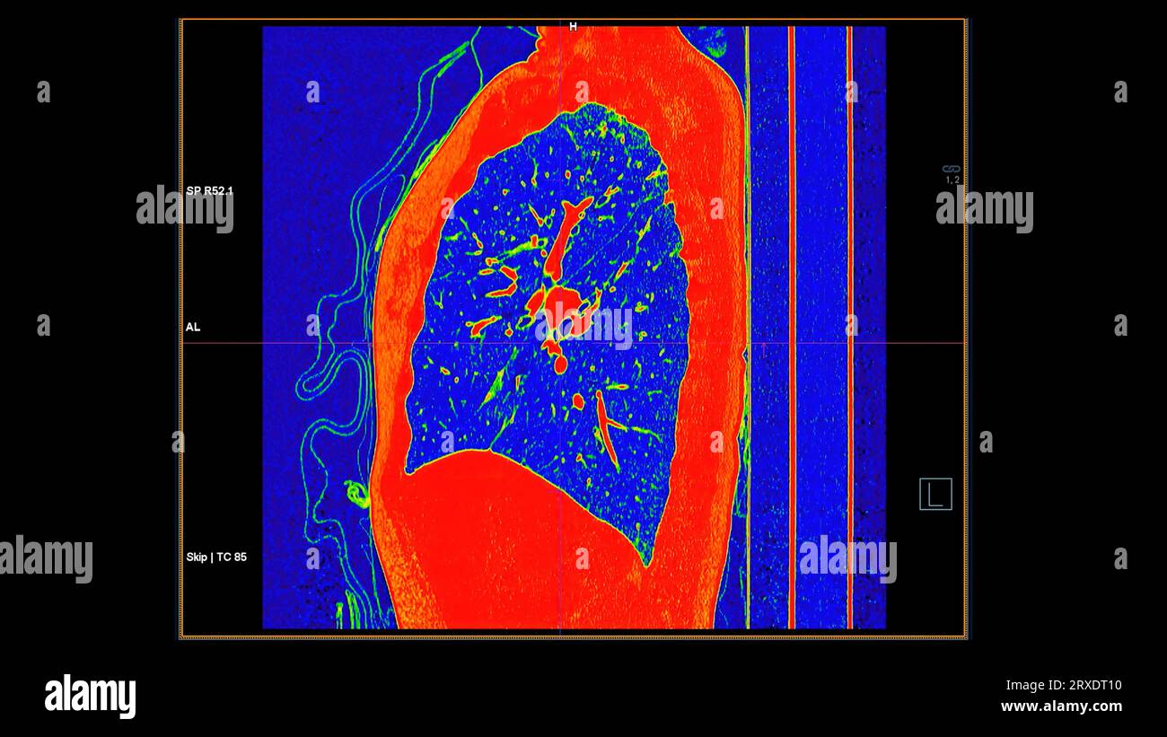 Tomodensitométrie de la vue coronale thorax en mode couleur pour le diagnostic d'embolie pulmonaire (EP) , de cancer du poumon et de covid-19. Banque D'Images