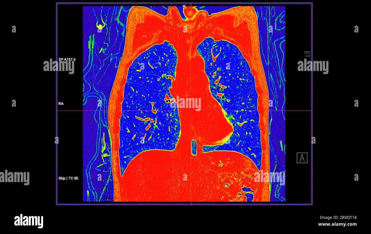 Tomodensitométrie de la vue coronale thorax en mode couleur pour le diagnostic d'embolie pulmonaire (EP) , de cancer du poumon et de covid-19. Banque D'Images