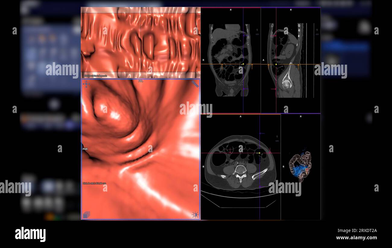 CT colonography compare les plans axial, sagittal, frontal 2D et 3D pour le dépistage du cancer colorectal. Pour les bilans de santé annuels à analyser Banque D'Images