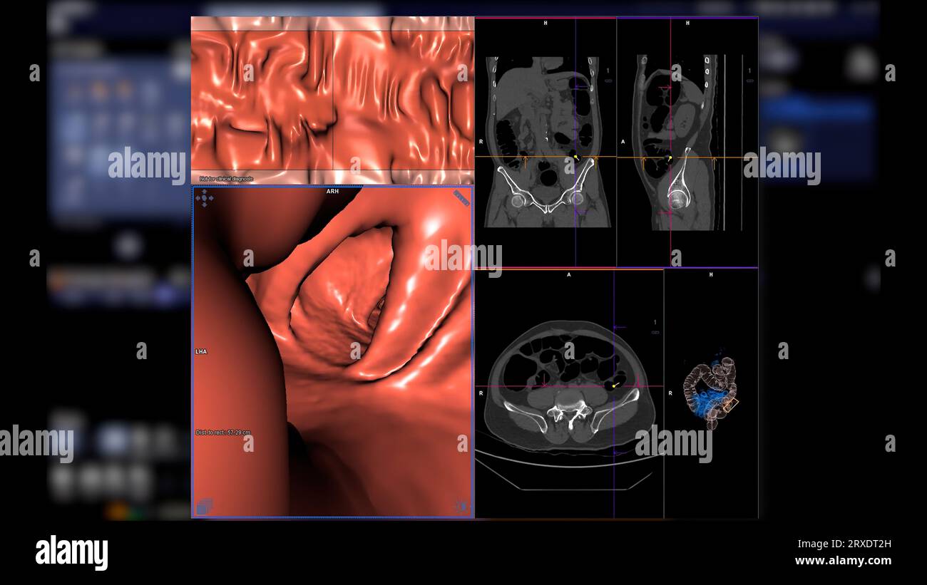 CT colonography compare les plans axial, sagittal, frontal 2D et 3D pour le dépistage du cancer colorectal. Pour les bilans de santé annuels à analyser Banque D'Images