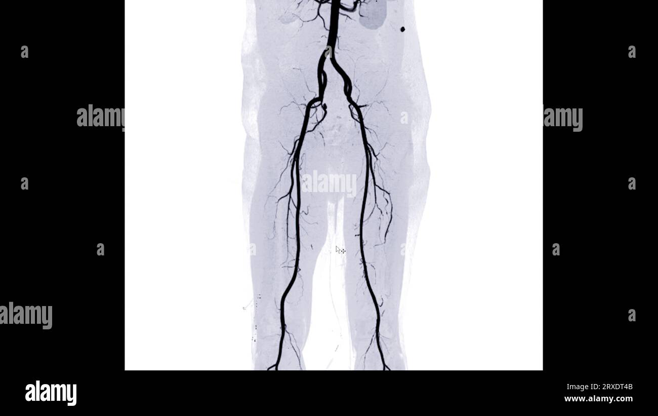 Anomalie de l'artère fémorale CTA montrant l'artère fémorale pour la maladie artérielle périphérique aiguë ou chronique diagnostique. Banque D'Images
