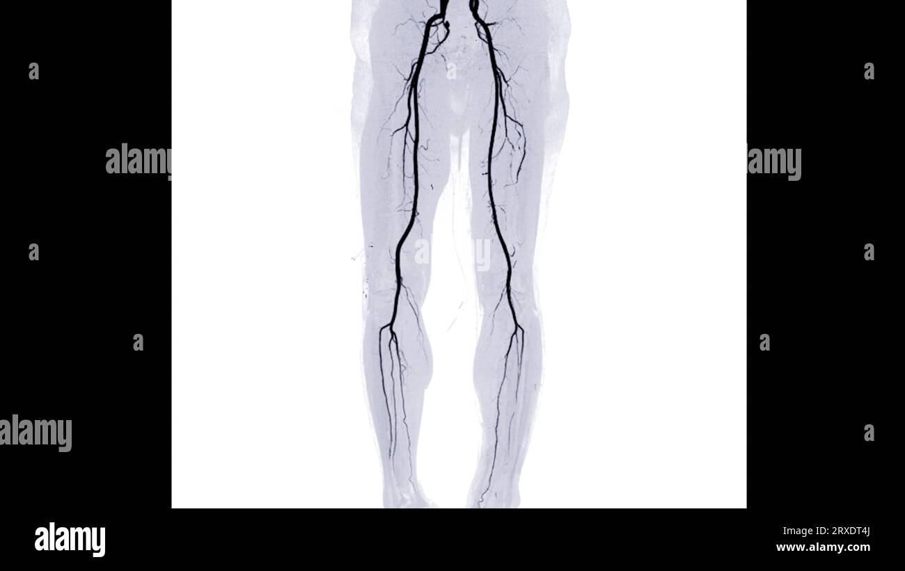 Anomalie de l'artère fémorale CTA montrant l'artère fémorale pour la maladie artérielle périphérique aiguë ou chronique diagnostique. Banque D'Images