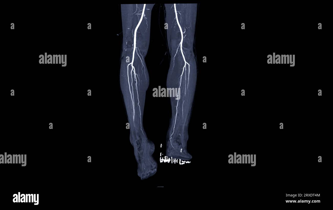 Anomalie de l'artère fémorale CTA montrant l'artère fémorale pour la maladie artérielle périphérique aiguë ou chronique diagnostique. Banque D'Images