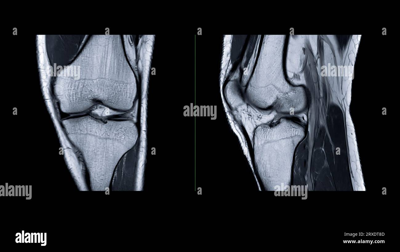 Imagerie par résonance magnétique de l'articulation du genou ou IRM sagittale du genou pour détecter la déchirure ou l'entorse du ligament croisé antérieur (LCA). Banque D'Images