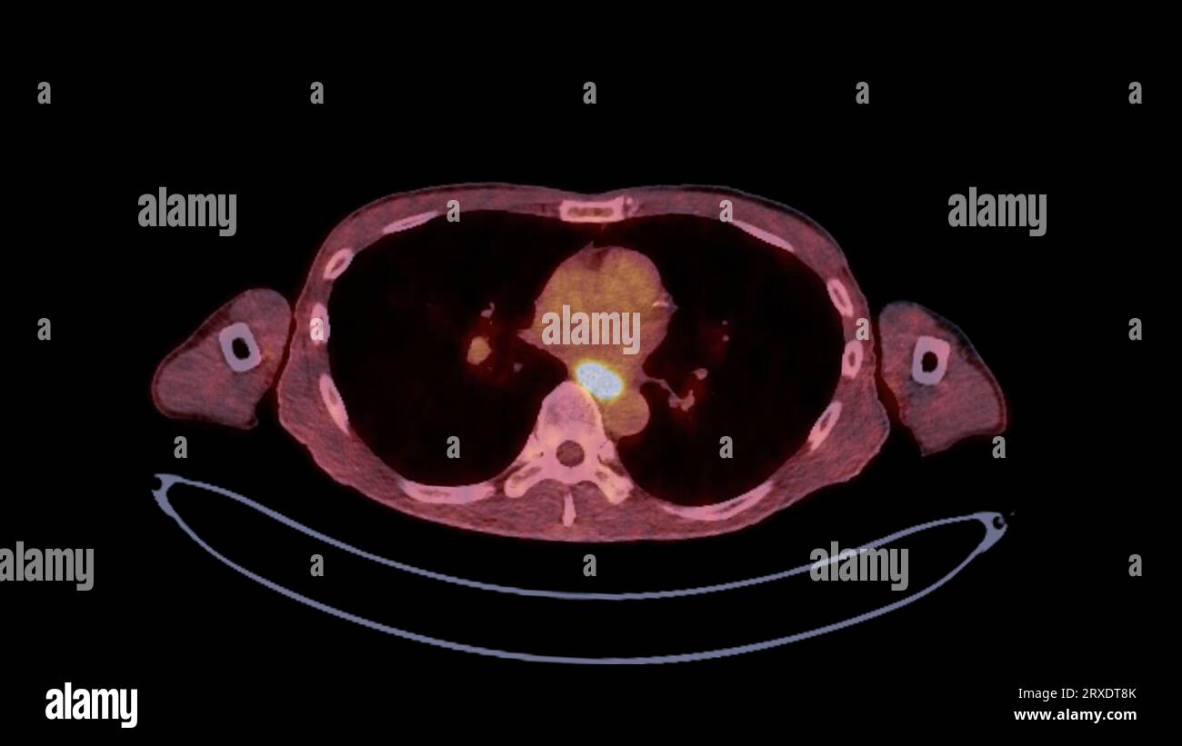 Image TEP CT du corps humain entier dans les plans axial, coronal et sagittal. Tomodensitométrie par émission de positons. Banque D'Images