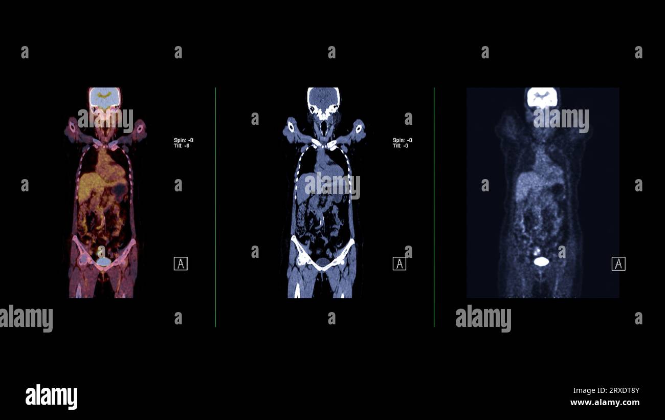 Image TEP CT du corps humain entier dans les plans axial, coronal et sagittal. Tomodensitométrie par émission de positons. Banque D'Images
