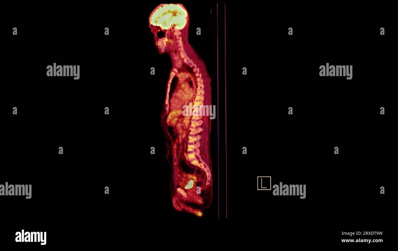 Image PET CT du plan sagittal du corps humain entier. Tomodensitométrie par émission de positons. Banque D'Images