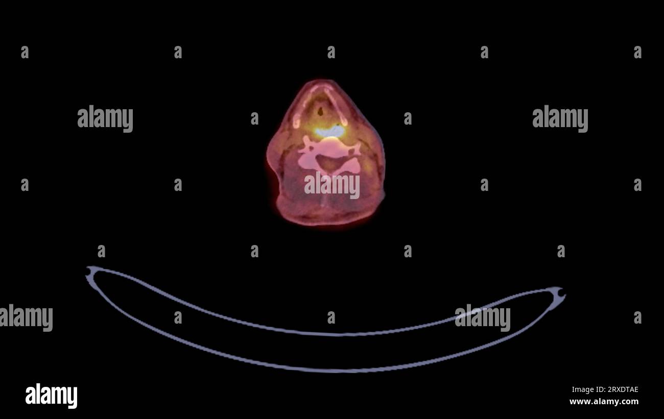 Image PET CT du plan axial du corps humain entier. Tomodensitométrie par émission de positons. Banque D'Images