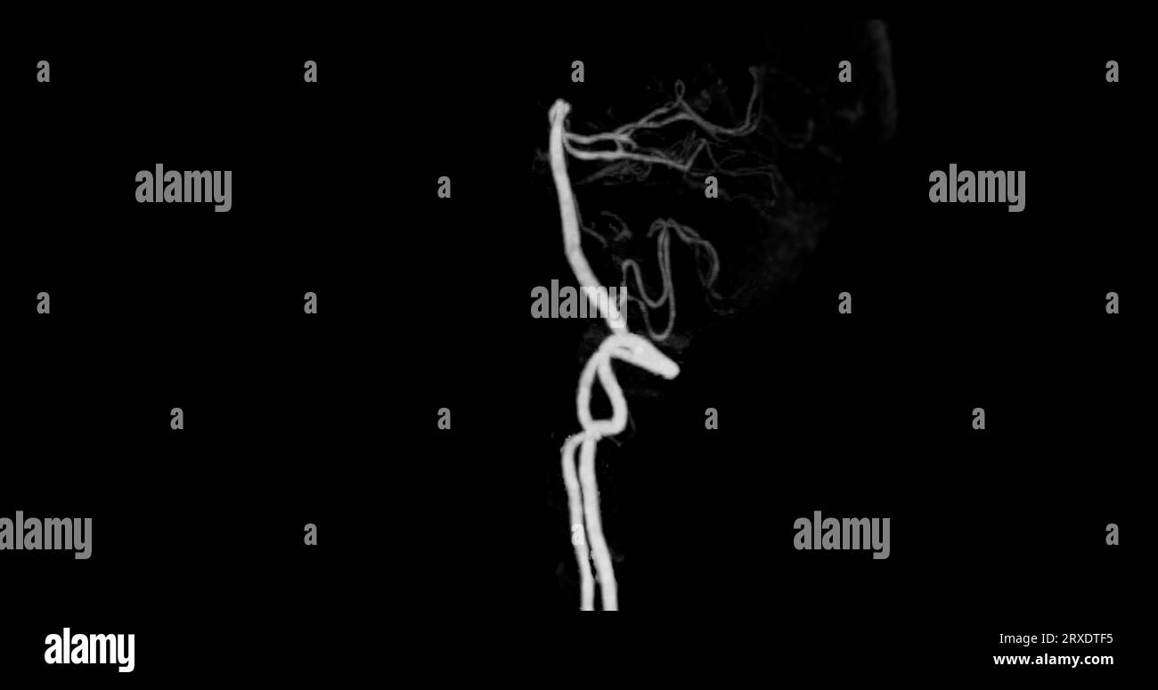 Angiographie angiographique CÉRÉBRALE par tomodensitométrie du cerveau montrant une artère basilaire. Banque D'Images