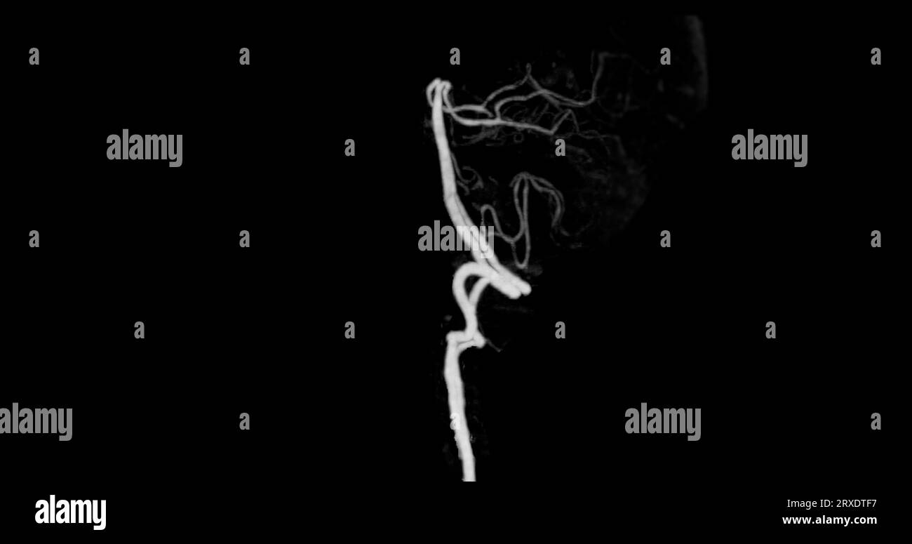 Angiographie angiographique CÉRÉBRALE par tomodensitométrie du cerveau montrant une artère basilaire. Banque D'Images