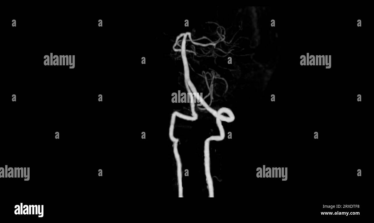 Angiographie angiographique CÉRÉBRALE par tomodensitométrie du cerveau montrant une artère basilaire. Banque D'Images