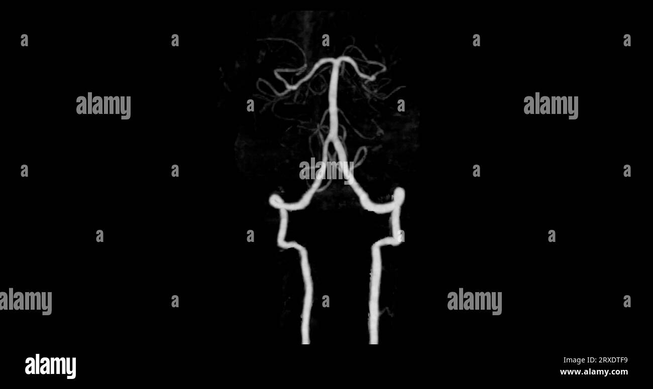 Angiographie angiographique CÉRÉBRALE par tomodensitométrie du cerveau montrant une artère basilaire. Banque D'Images
