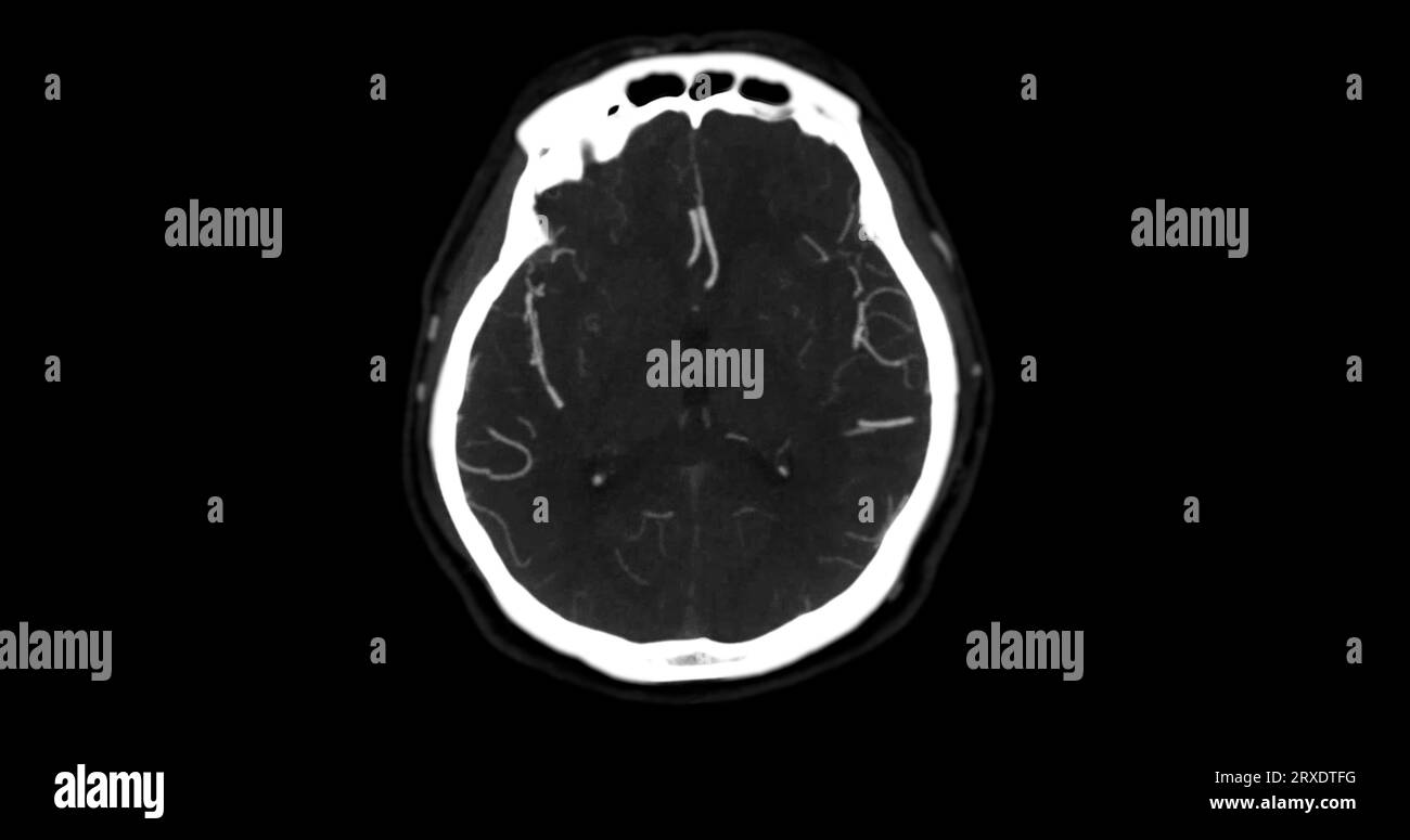 Angiographie angiographique angiographique angiographique TDM de la vue mip axiale du cerveau montrant l'artère cérébrale. Banque D'Images
