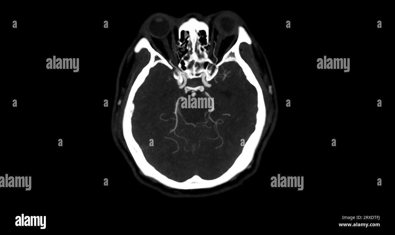 Angiographie angiographique angiographique angiographique TDM de la vue mip axiale du cerveau montrant l'artère cérébrale. Banque D'Images
