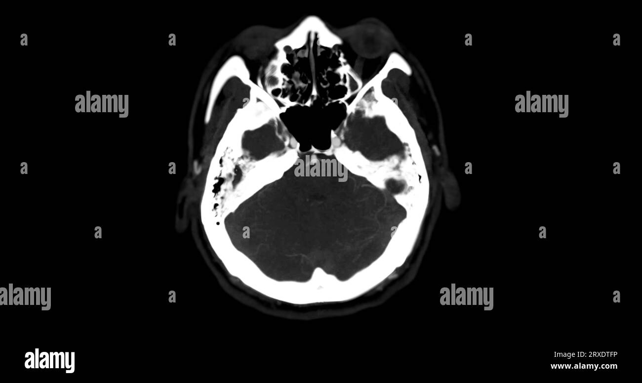 Angiographie angiographique angiographique angiographique TDM de la vue mip axiale du cerveau montrant l'artère cérébrale. Banque D'Images