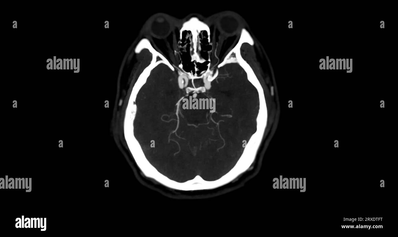 Angiographie angiographique angiographique angiographique TDM de la vue mip axiale du cerveau montrant l'artère cérébrale. Banque D'Images