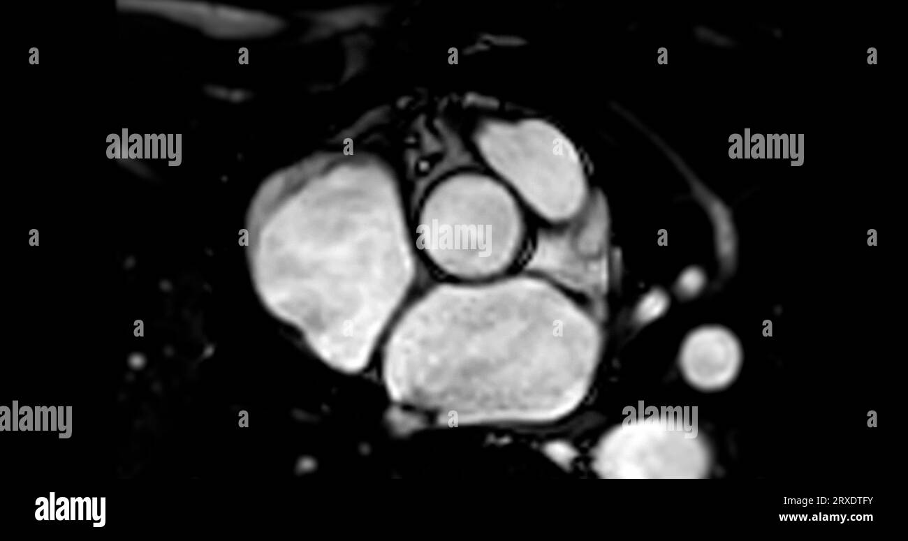 IRM cardiaque ou IRM cardiaque ( imagerie par résonance magnétique ) du coeur avec valvule aortique. Banque D'Images