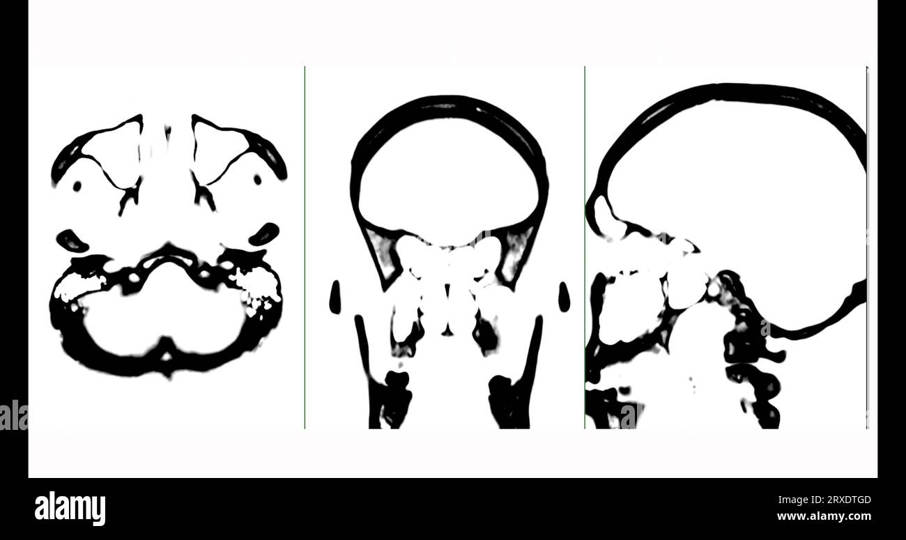 Tomodensitométrie du cerveau en mode noir et blanc, vue axiale, frontale et sagittale. Banque D'Images