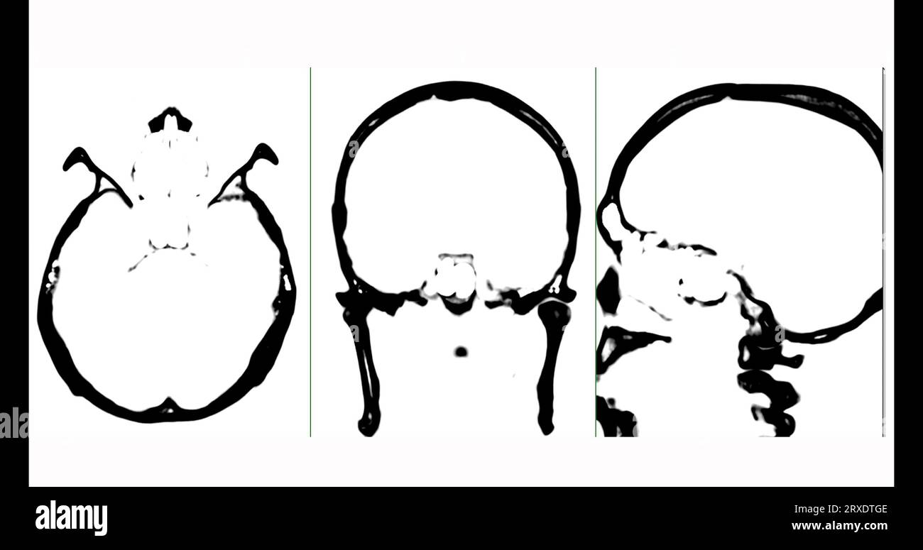 Tomodensitométrie du cerveau en mode noir et blanc, vue axiale, frontale et sagittale. Banque D'Images