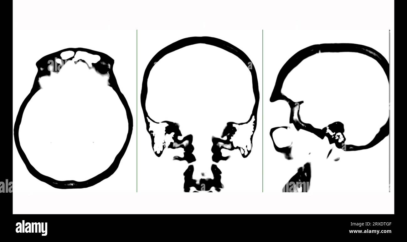 Tomodensitométrie du cerveau en mode noir et blanc, vue axiale, frontale et sagittale. Banque D'Images