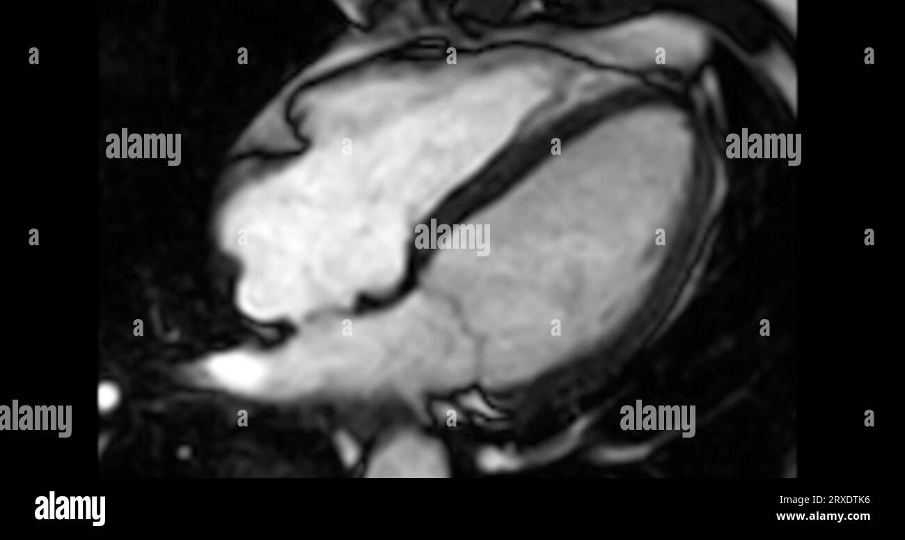 IRM cœur ou IRM cardiaque ( imagerie par résonance magnétique ) du cœur en vue de l'axe court montrant le battement du cœur de 4 cavités pour détecter la maladie cardiaque. Banque D'Images