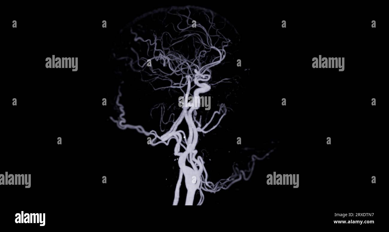 Angiographie angiographique angiographique angiographique TDM de la technique MIP cérébrale, vue AP et latérale montrant l'artère cérébrale. Banque D'Images