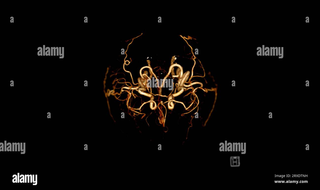 Angiographie angiographique angiographique du cerveau par tomodensitométrie du cerveau en 3D image AP et vue latérale montrant l'artère cérébrale. Banque D'Images