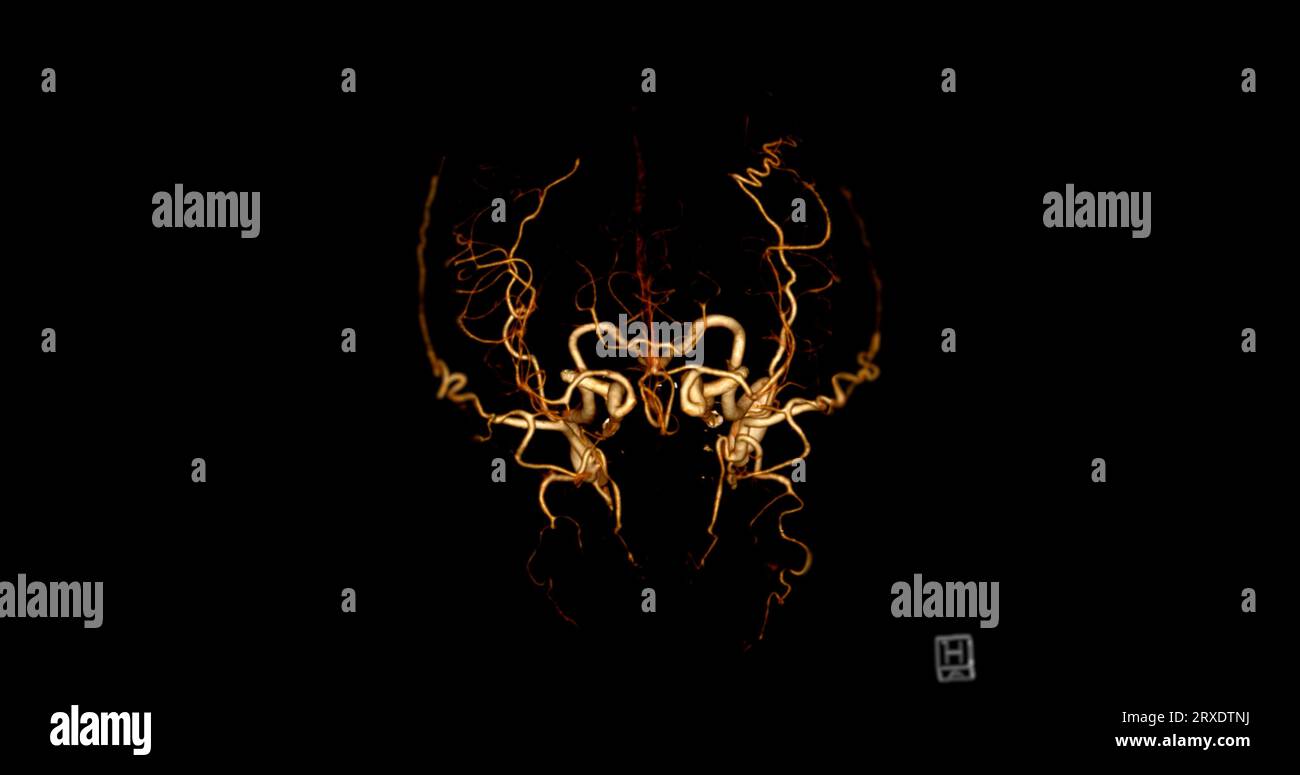 Angiographie angiographique angiographique du cerveau par tomodensitométrie du cerveau en 3D image AP et vue latérale montrant l'artère cérébrale. Banque D'Images