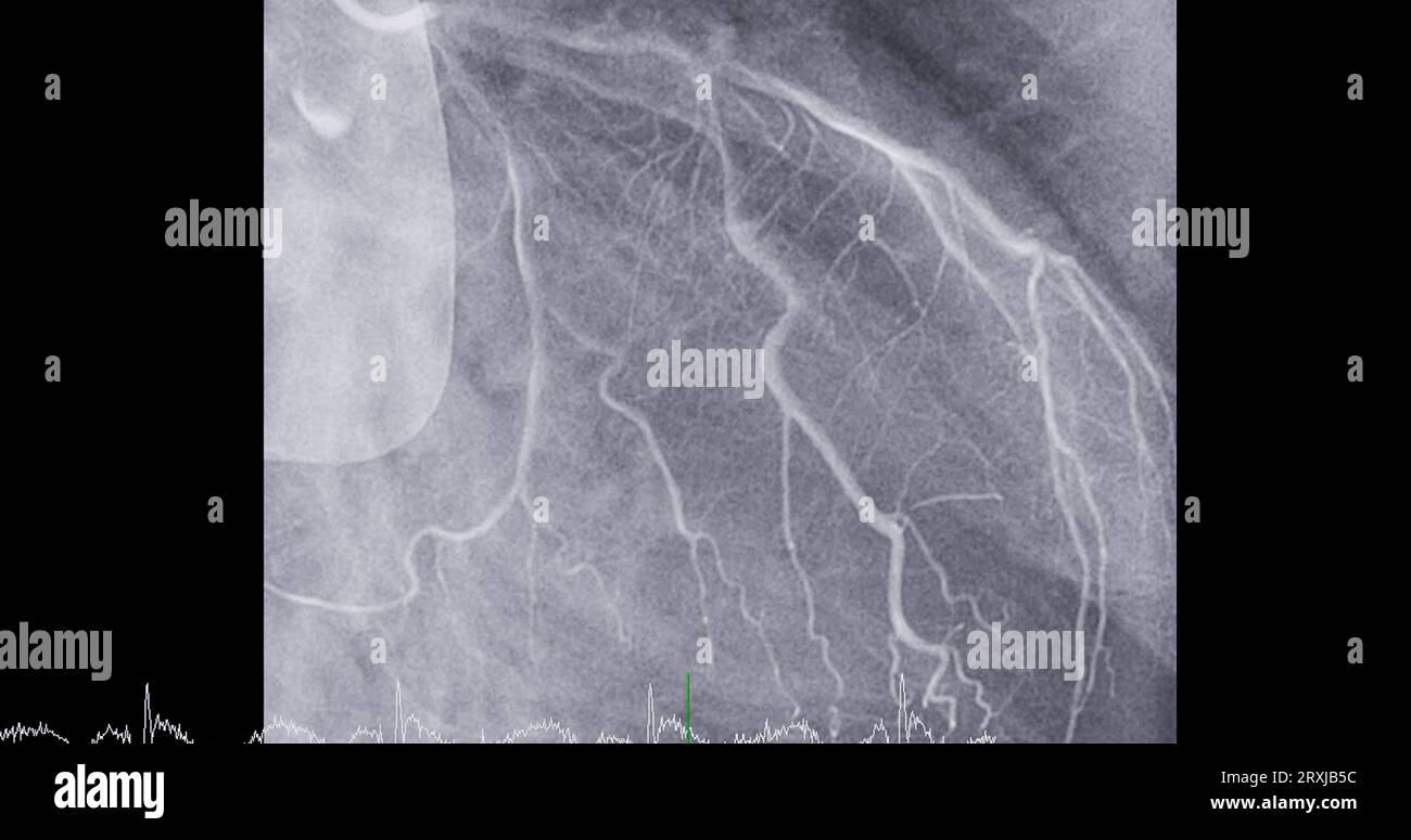 Le cathétérisme cardiaque sur l'artère descendante antérieure gauche (LAD) peut aider le médecin à diagnostiquer et à traiter des problèmes dans votre cœur et vos vaisseaux sanguins tels que Banque D'Images