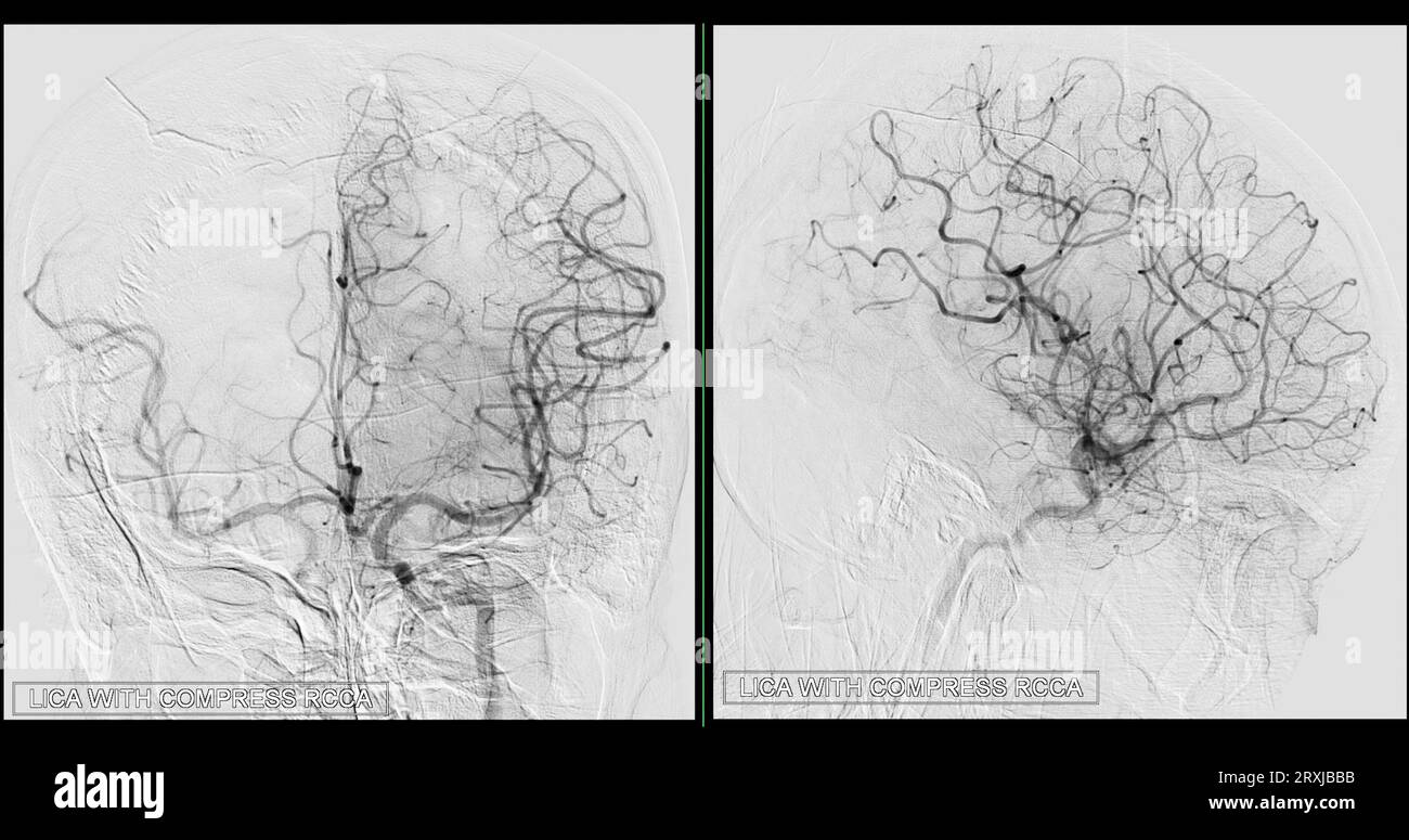 Image d'angiographie cérébrale issue de la fluoroscopie en radiologie d ...