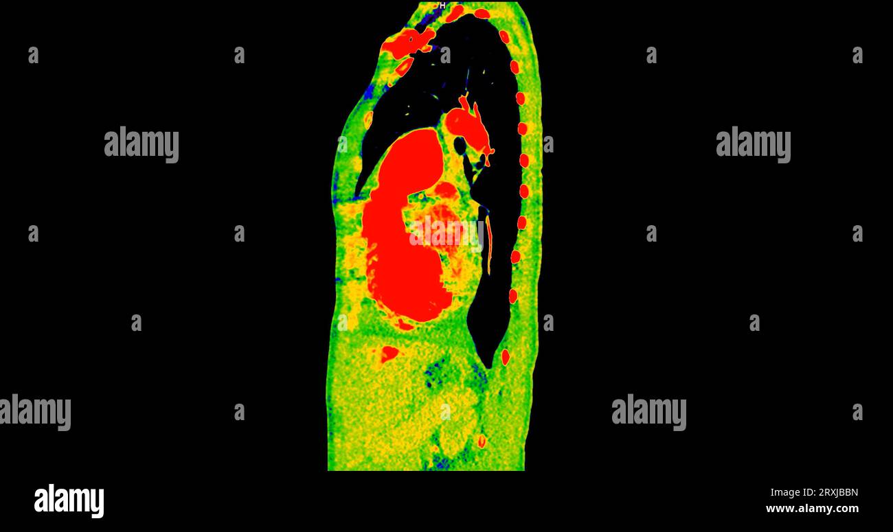 Tomodensitométrie de la vue sagittale thorax en mode couleur pour le diagnostic d'embolie pulmonaire (EP) , de cancer du poumon et de covid-19. Banque D'Images