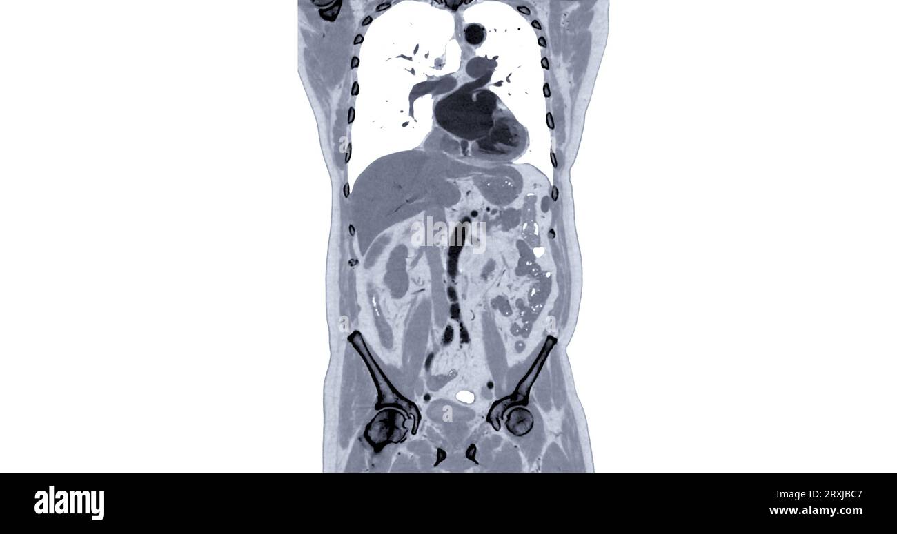 TDM thorax et abdomen avec vue frontale de produit de contraste pour injection pour le diagnostic des douleurs thoraciques et abdominales. Banque D'Images