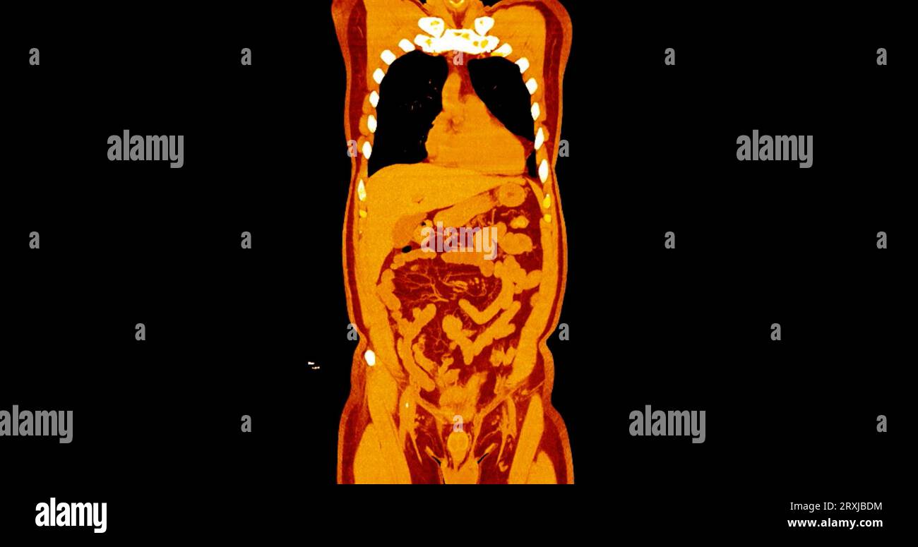 TDM thorax et abdomen avec vue frontale de produit de contraste pour injection pour le diagnostic des douleurs thoraciques et abdominales. Banque D'Images
