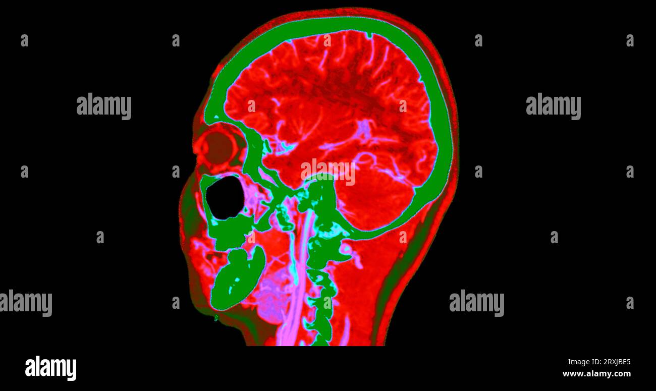 Angiographie TDM du cerveau ou angiographie angiographique du cerveau et du cou vue sagittale 3D mode de fusion d'images . concept de technologie médicale. Banque D'Images