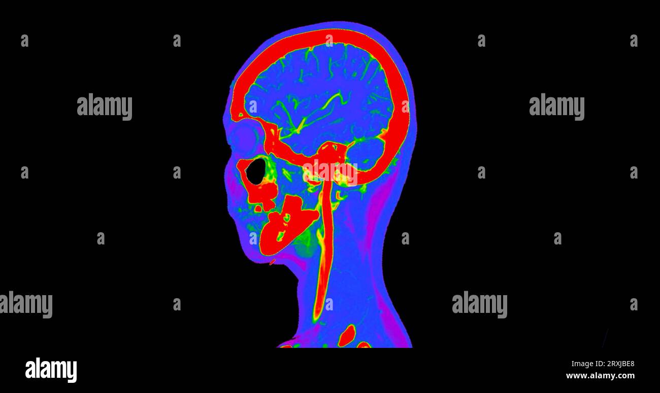 Angiographie TDM du cerveau ou angiographie angiographique du cerveau et du cou vue sagittale 3D mode de fusion d'images . concept de technologie médicale. Banque D'Images