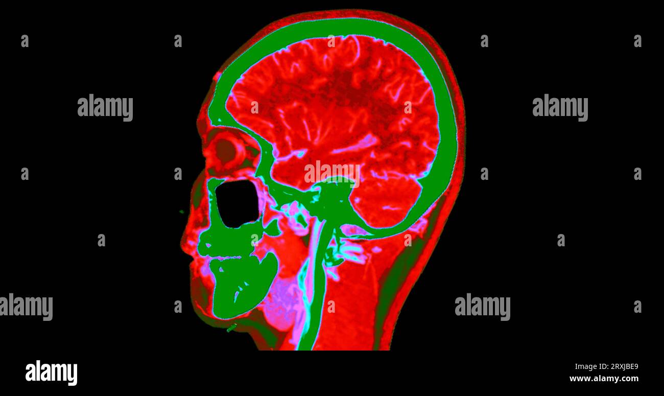 Angiographie TDM du cerveau ou angiographie angiographique du cerveau et du cou vue sagittale 3D mode de fusion d'images . concept de technologie médicale. Banque D'Images