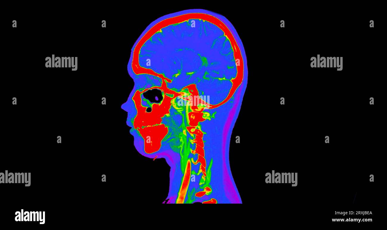 Angiographie TDM du cerveau ou angiographie angiographique du cerveau et du cou vue sagittale 3D mode de fusion d'images . concept de technologie médicale. Banque D'Images