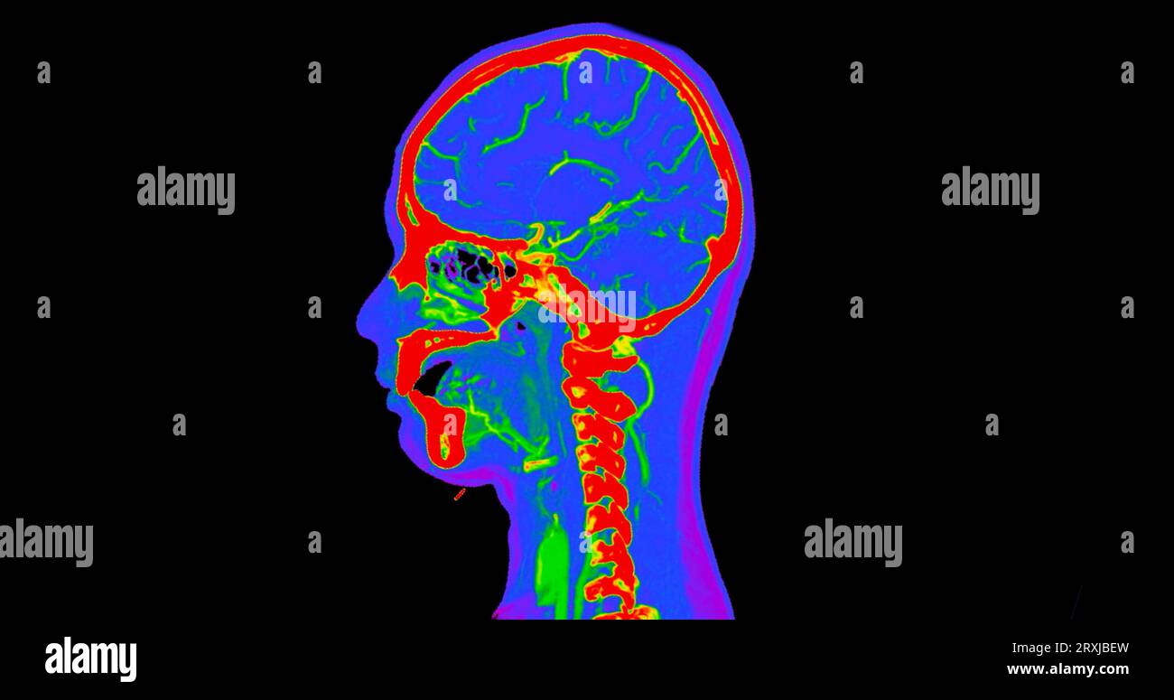 Angiographie TDM du cerveau ou angiographie angiographique du cerveau et du cou vue sagittale 3D mode de fusion d'images . concept de technologie médicale. Banque D'Images