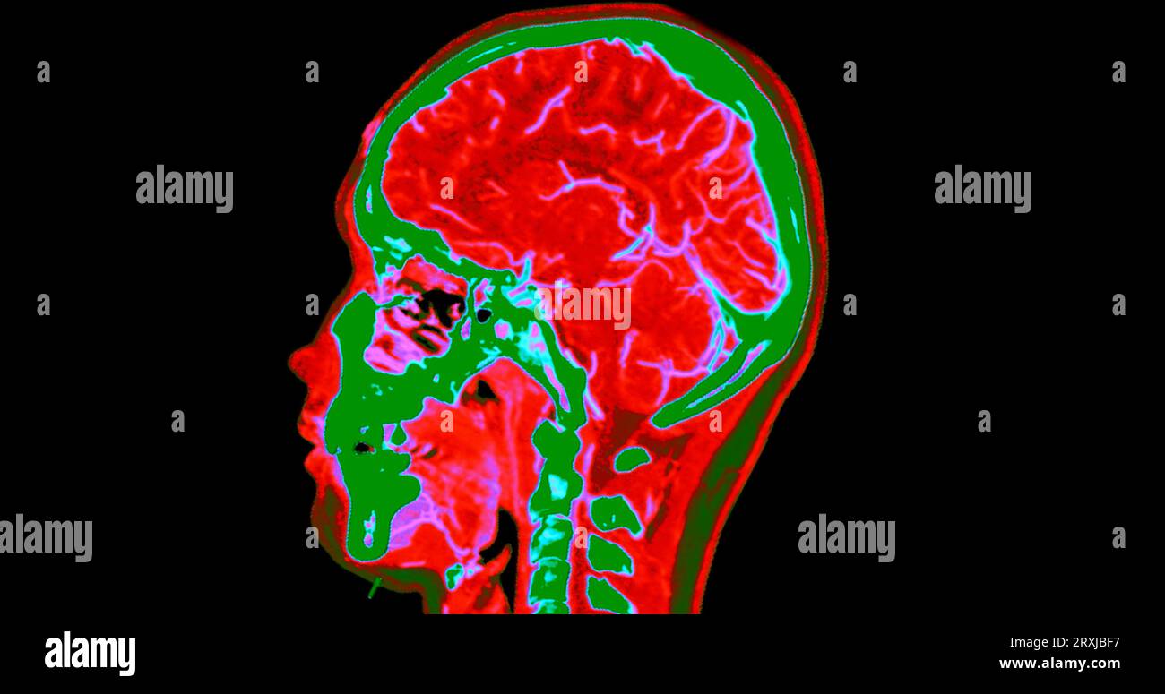 Angiographie TDM du cerveau ou angiographie angiographique du cerveau et du cou vue sagittale 3D mode de fusion d'images . concept de technologie médicale. Banque D'Images