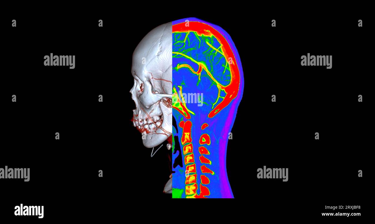Angiographie TDM du cerveau ou angiographie angiographique du cerveau et du cou vue sagittale 3D mode de fusion d'images . concept de technologie médicale. Banque D'Images