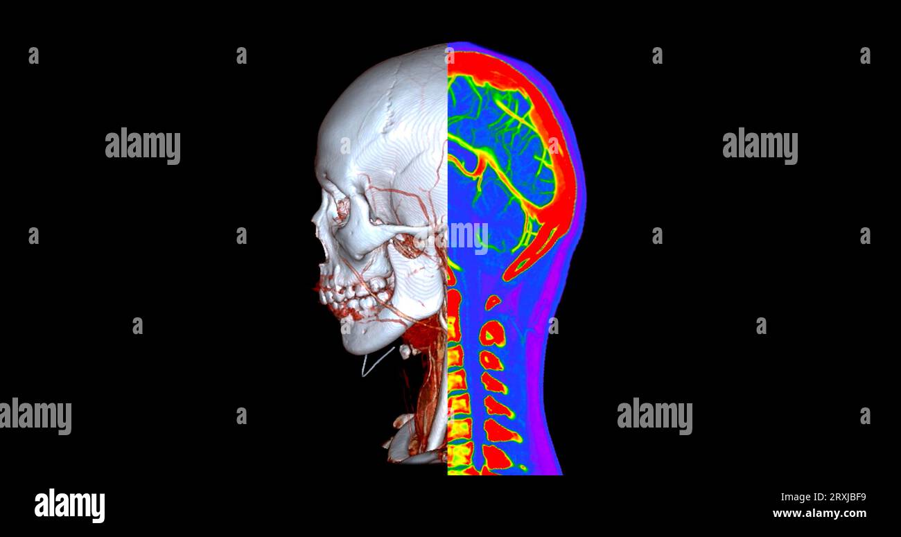 Angiographie TDM du cerveau ou angiographie angiographique du cerveau et du cou vue sagittale 3D mode de fusion d'images . concept de technologie médicale. Banque D'Images