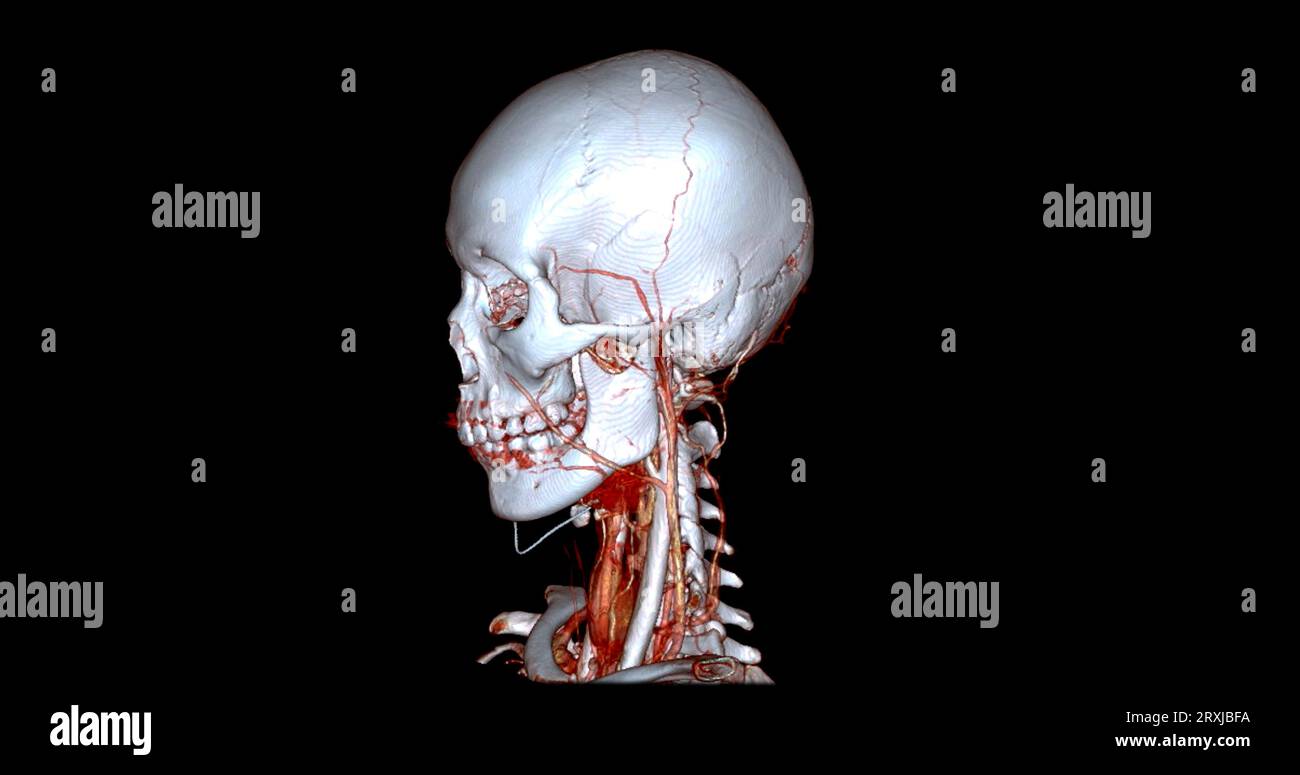 Angiographie TDM du cerveau ou angiographie angiographique du cerveau et du cou vue sagittale 3D mode de fusion d'images . concept de technologie médicale. Banque D'Images