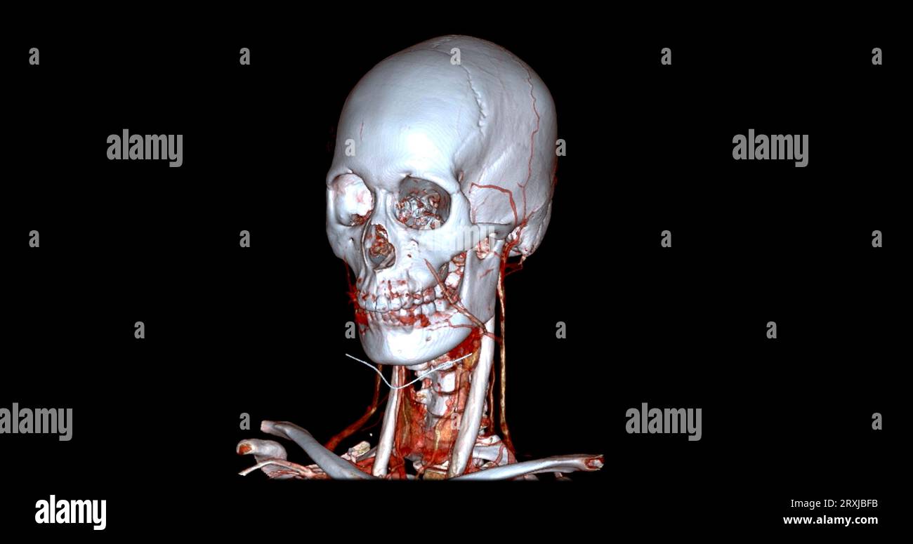 Angiographie TDM du cerveau ou angiographie angiographique du cerveau et du cou vue sagittale 3D mode de fusion d'images . concept de technologie médicale. Banque D'Images